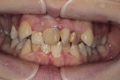 Кривые зубы – что делать?